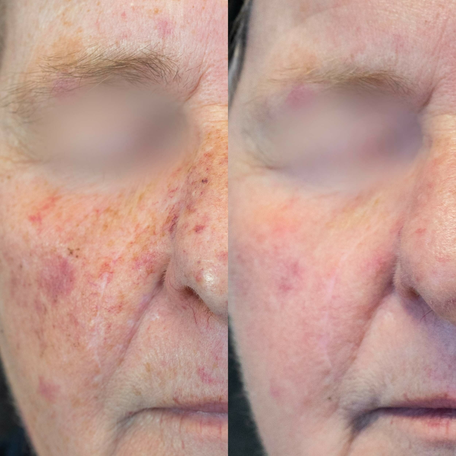 Zonschade verminderen huidtherapeut groenlo