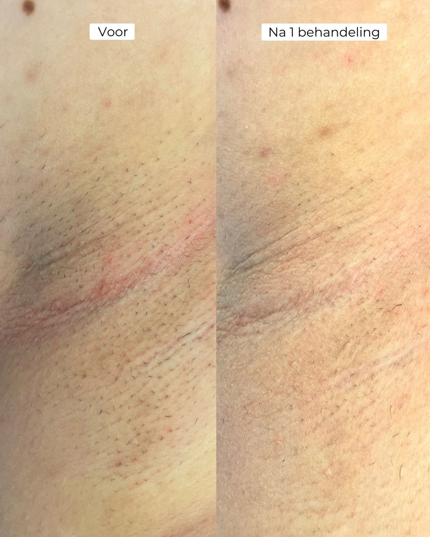 Laserontharing oksels