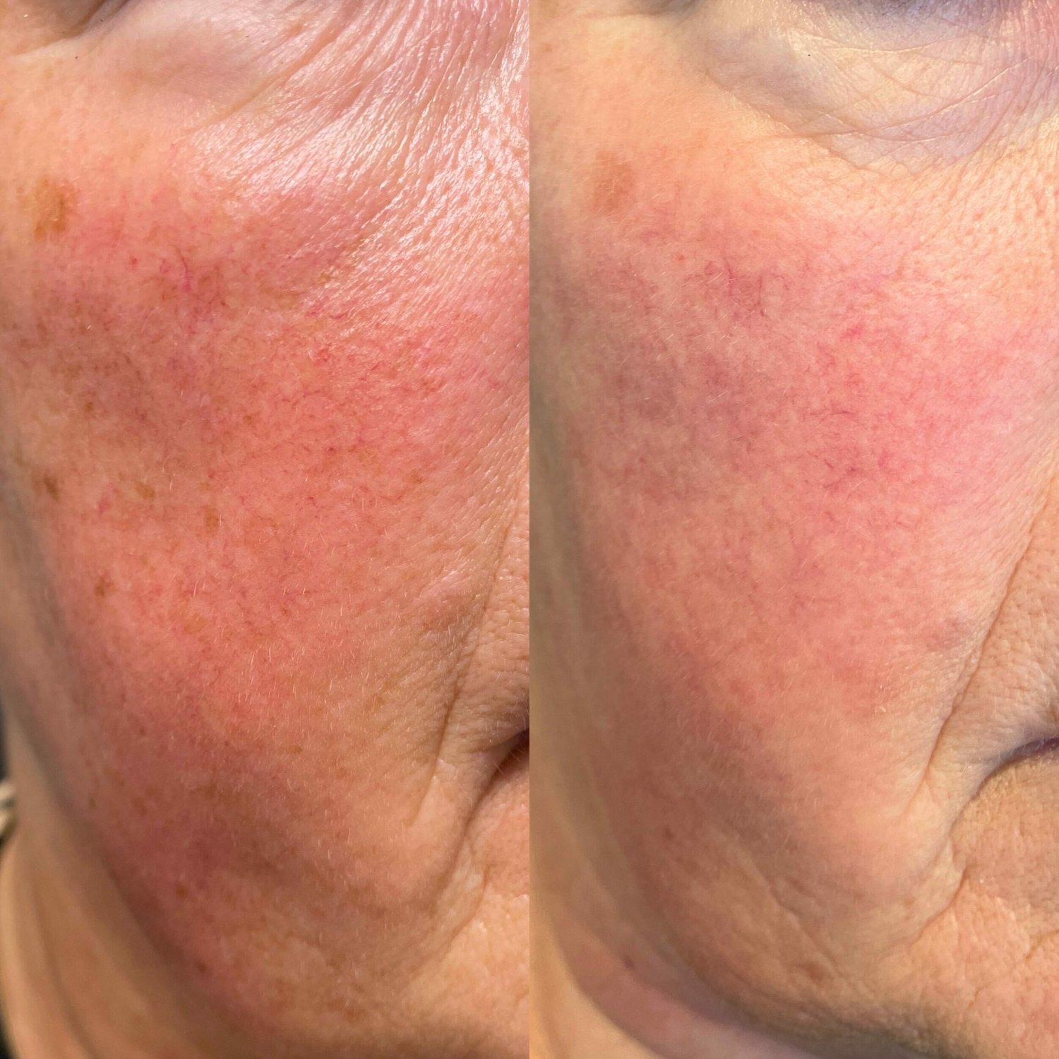 Roodheid behandelen Groenlo